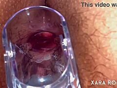 Speculum ermöglicht Sicht bei analer Untersuchung