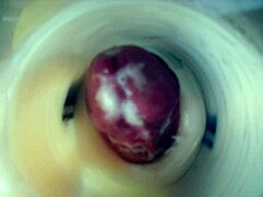 Endoscopic Double Cum