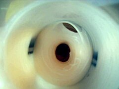 Endoscopic Double Cum