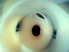 Endoscopic Double Cum