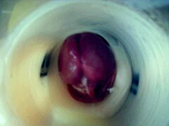 Endoscopic Double Cum