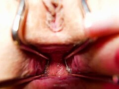 Speculum Gape